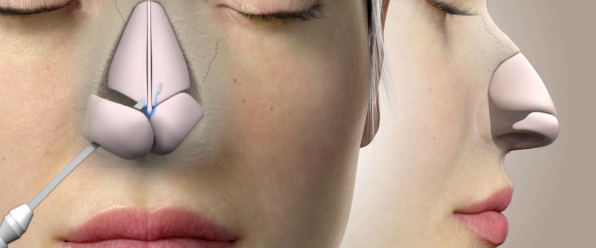 The Rise of South Korea as the Top Destination for Rhinoplasty