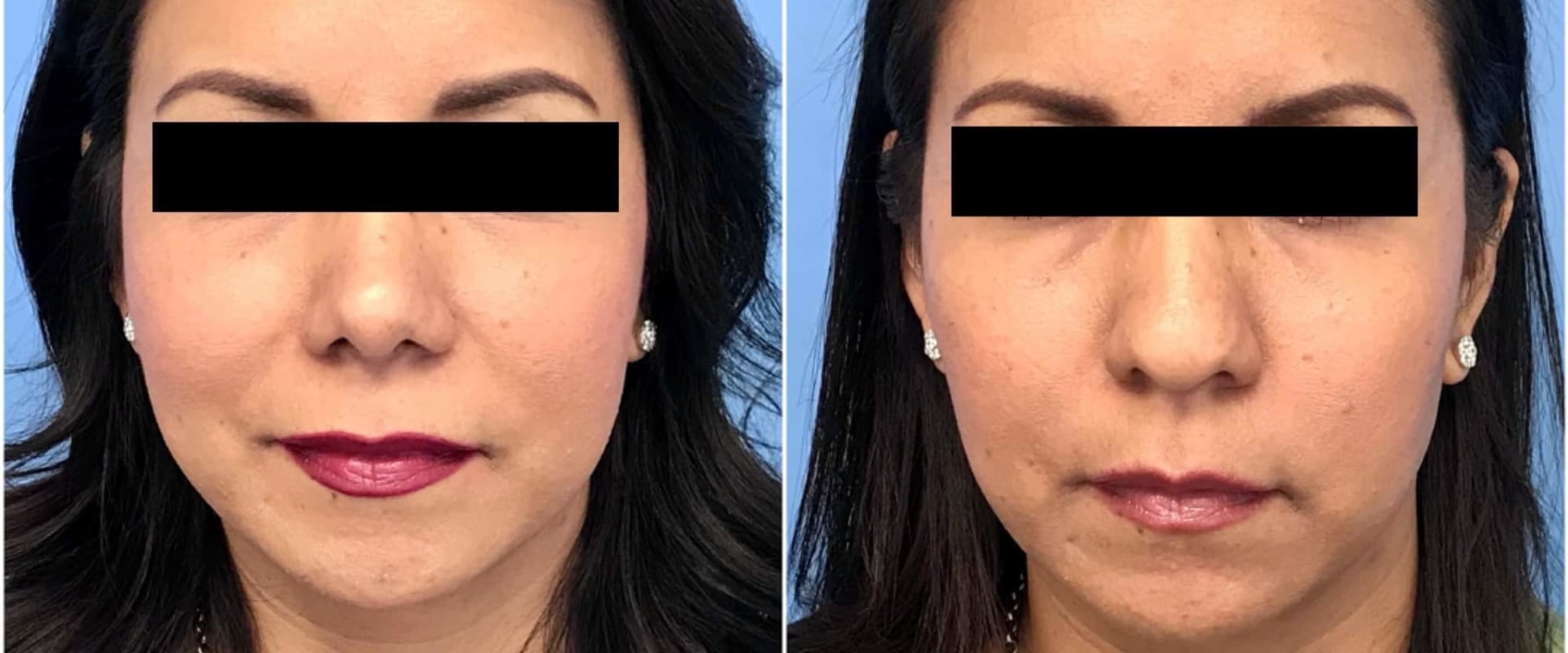 The True Cost of Tip Rhinoplasty: What You Should Know