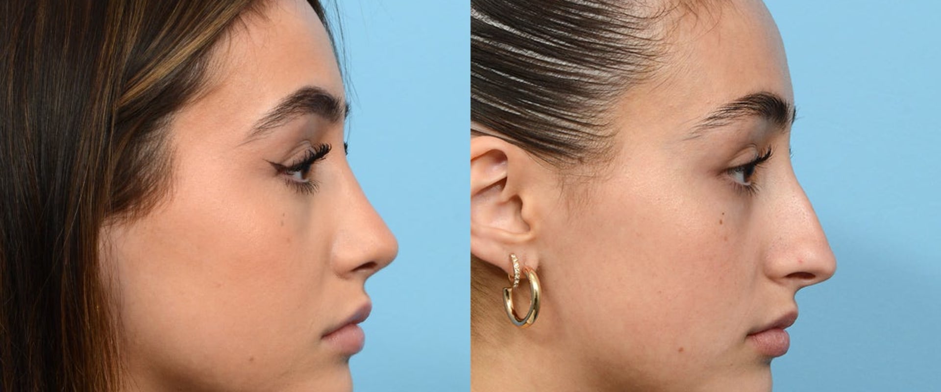 The Ultimate Guide to Rhinoplasty Abroad: Expert Insights