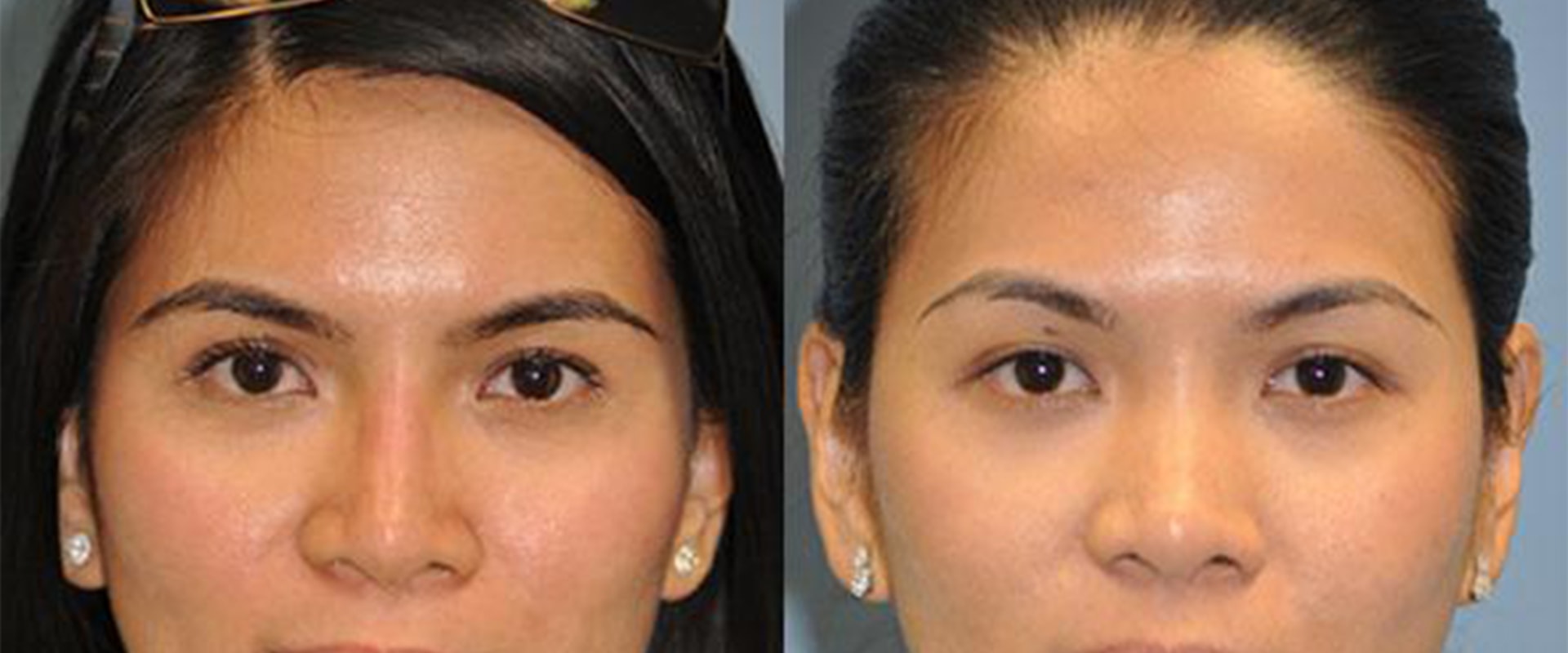 Liquid Rhinoplasty: A Non-Surgical Alternative for Nose Reshaping