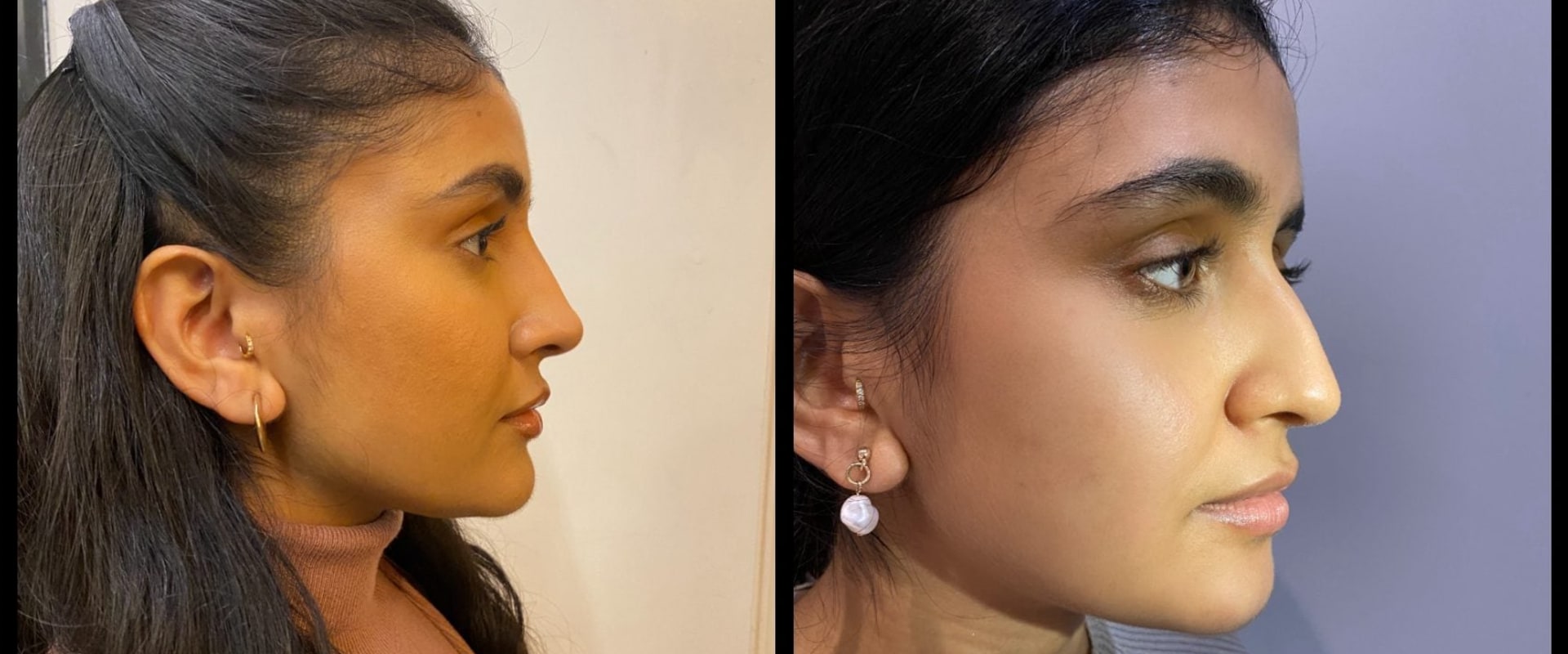 The True Cost of a Nose Job: What You Need to Know