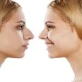 The True Cost of Rhinoplasty: How to Budget for a Life-Changing Nose Job