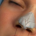 The True Cost of Rhinoplasty: What You Need to Know