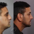 The Evolution of Tip Plasty Surgery