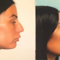 The Affordable and Safe Options for Rhinoplasty