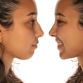 The Truth About Nose Jobs: An Expert's Perspective