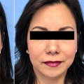 The True Cost of Tip Rhinoplasty: What You Should Know