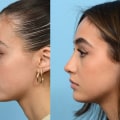 The Ultimate Guide to Rhinoplasty Abroad: Expert Insights