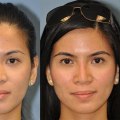 Liquid Rhinoplasty: A Non-Surgical Alternative for Nose Reshaping