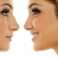 The Ultimate Guide to Getting a Nose Job in South Korea: An Expert's Perspective