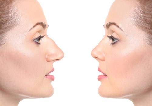 The True Cost of Rhinoplasty: What You Need to Know