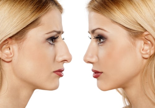 The Longevity of a Nose Job: What to Expect and How to Maintain It