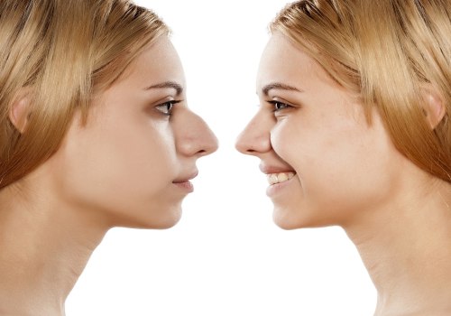 The True Cost of Rhinoplasty: How to Budget for a Life-Changing Nose Job