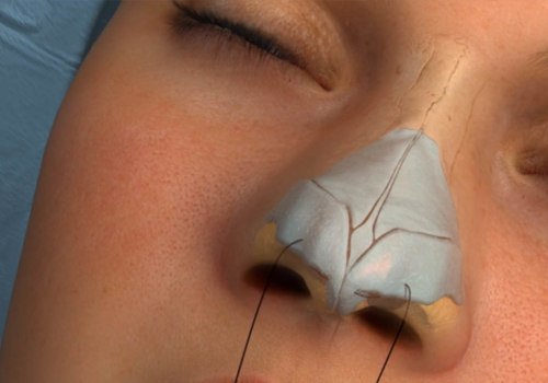 The True Cost of Rhinoplasty: What You Need to Know