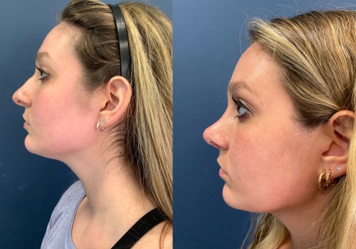The Truth About the Longevity of a Nose Job