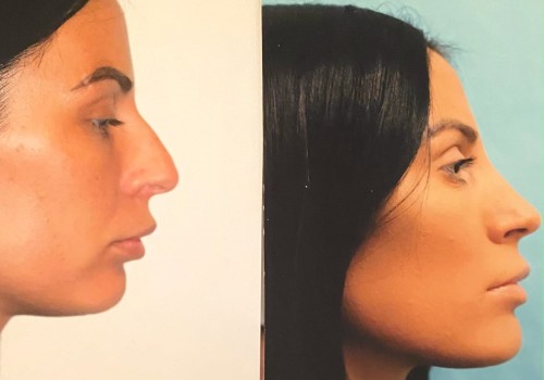 The Affordable and Safe Options for Rhinoplasty