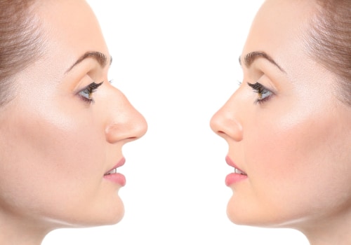 Where is the most affordable place to get a rhinoplasty?