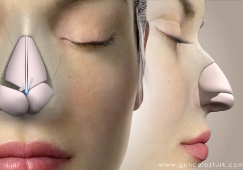 The Rise of South Korea as the Top Destination for Rhinoplasty