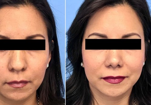 The True Cost of Tip Rhinoplasty: What You Should Know