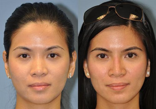 The Game-Changing Benefits of Silikon-1000 for Permanent Nose Sculpting